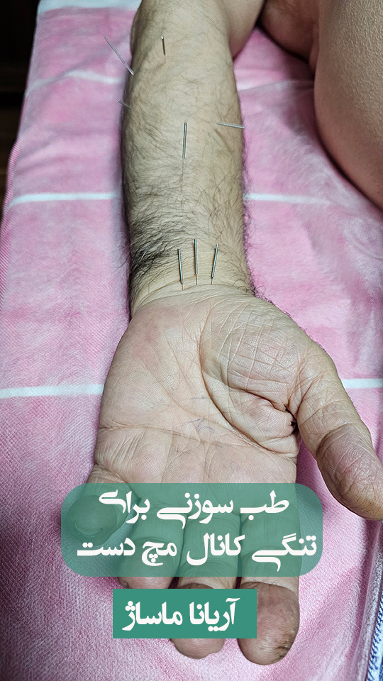 طب سوزنی برای درد مچ دست