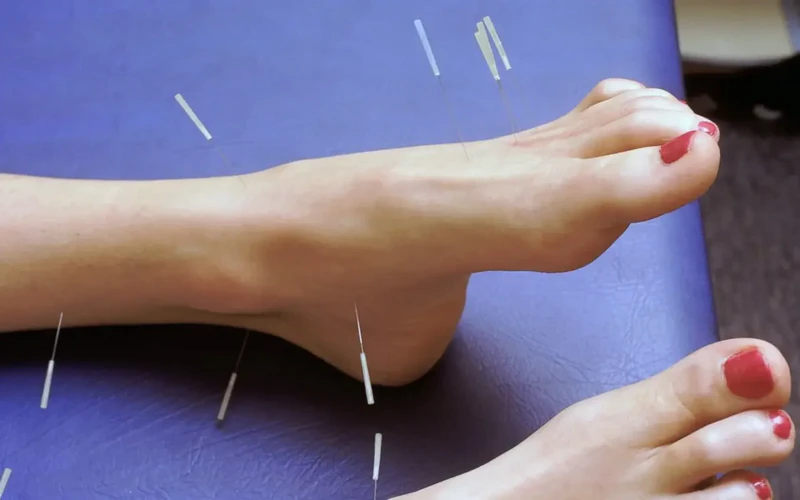 طب سوزنی برای پا درد