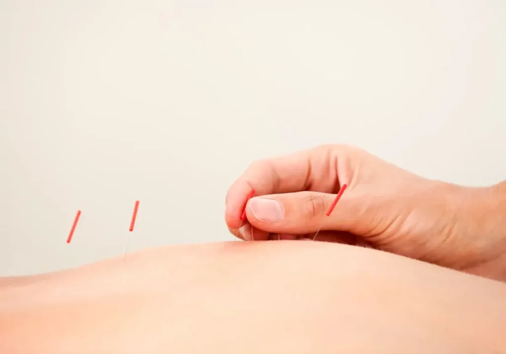 طب سوزنی برای افزایش قد