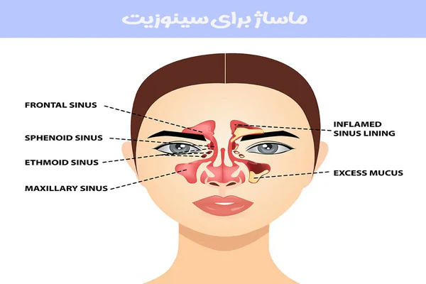 ماساژ سینوزیت