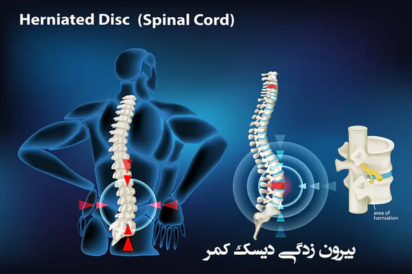 ماساژ درمانی برای کمر درد