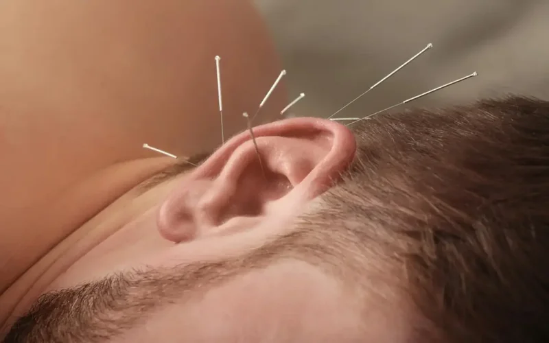 نقاط طب سوزنی گوش