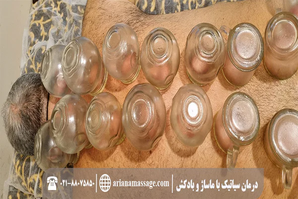 درمان سیاتیک با ماساژ و بادکش