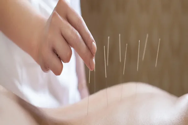 تجربه لاغری با طب سوزنی: نظرات کاربران