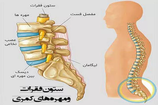دیسک کمر و درمان دیسک کمر