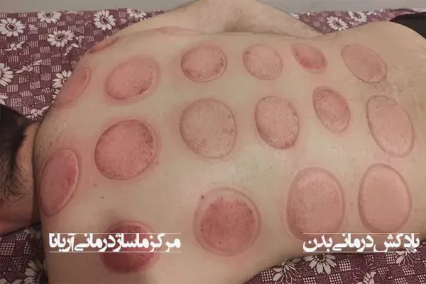 بادکش درمانی بدن