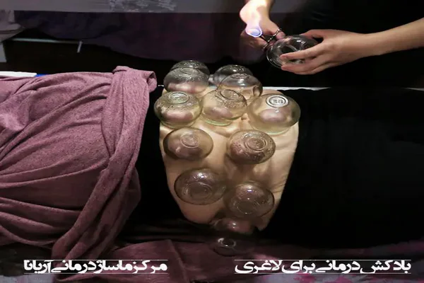 بادکش درمانی برای لاغری